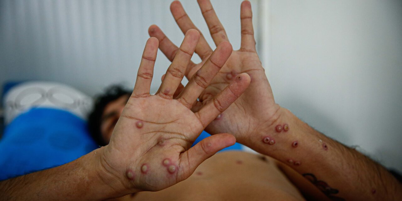 OMS en alerta máxima por aumento de casos de Mpox en la República Democrática del Congo
