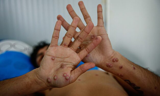 OMS en alerta máxima por aumento de casos de Mpox en la República Democrática del Congo