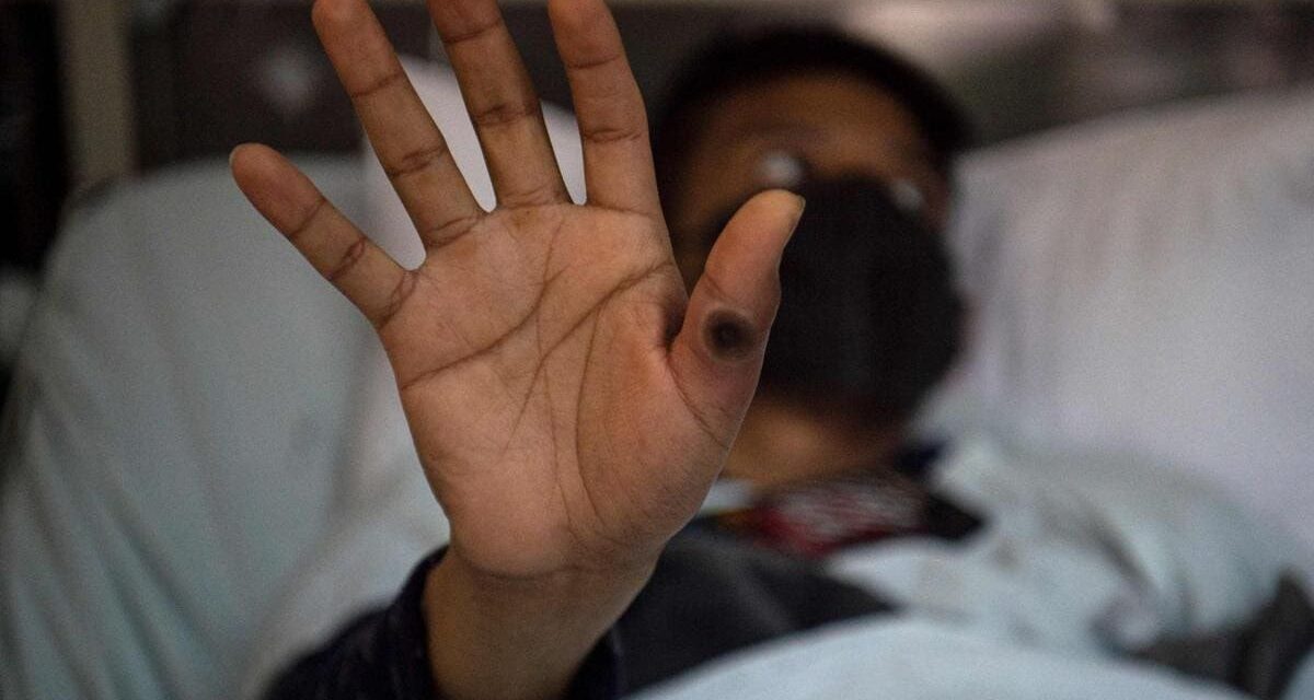 Se mantiene la alerta global por la epidemia de mpox