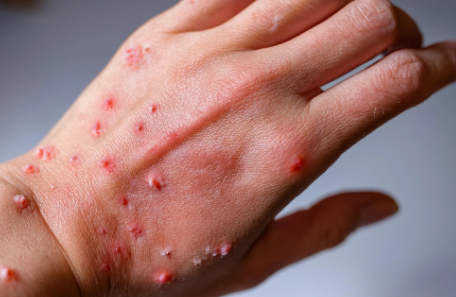 OMS levanta la emergencia sanitaria internacional por Mpox