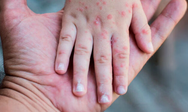 Campaña contra el sarampión en El Salvador