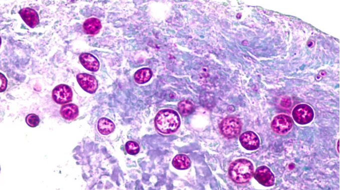 EE. UU. registra más de 11,000 casos en el mayor brote de ciclosporiasis de su historia
